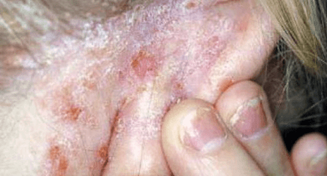 Psoriaris.